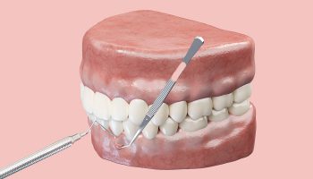 Know About Procedure and Recovery of Gum Grafting