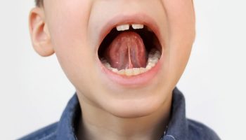 What is Frenectomy, Its Procedure, Types, Benefits & Recovery Tips