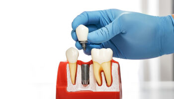 Dental Implants vs. Other Options: Why Houston, TX Patients Prefer Implants