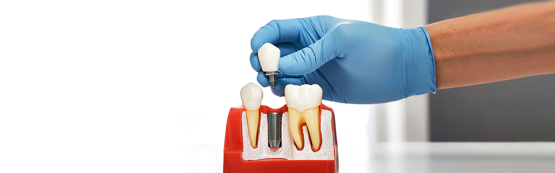 Dental Implants vs. Other Options: Why Houston, TX Patients Prefer Implants