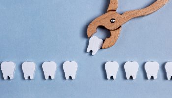 5 Things to Know Before Your Tooth Extraction in Houston