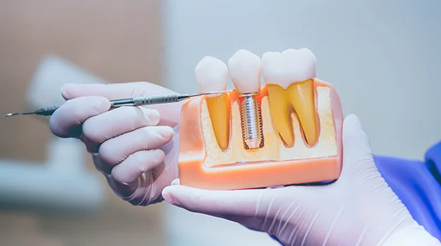 Abutment & Crown Placement